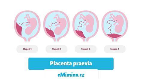 Predná placenta na ultrazvukovom vyšetrení