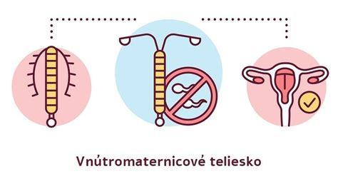 Mirena vnútromaternicové teliesko schéma