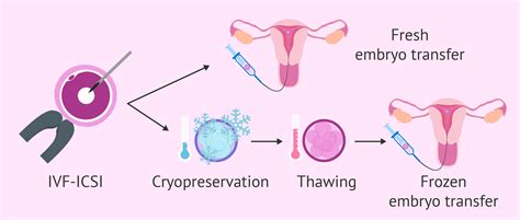Darované vajíčka a embryo transfer