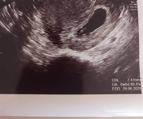Embryo v 7. týždni tehotenstva ultrazvuk