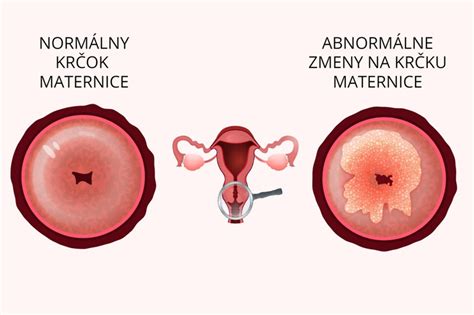 Symptotermálna tabuľka a zmeny krčka maternice