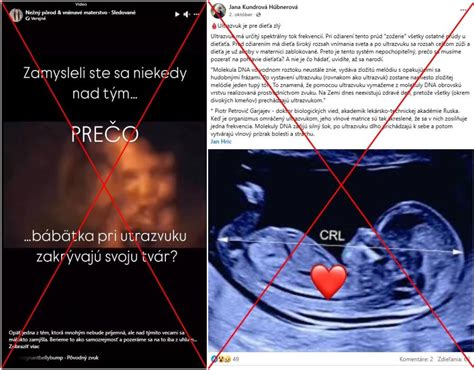 prenatálny ultrazvuk obličiek plodu